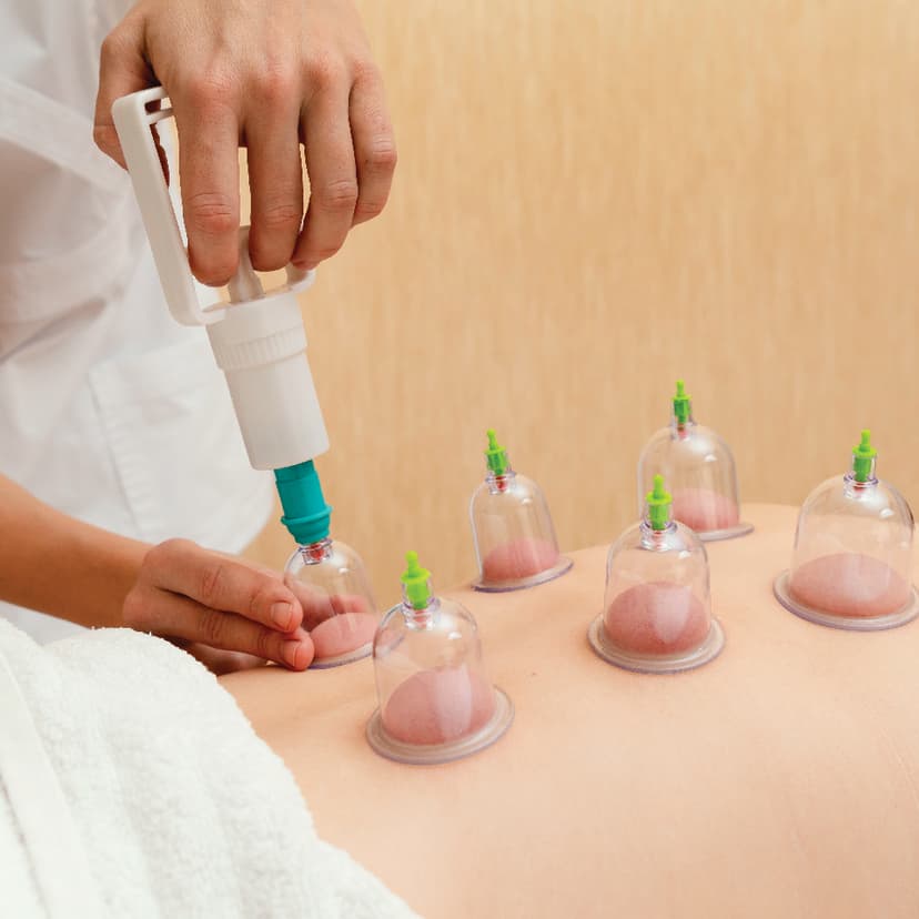 Cupping Therapy