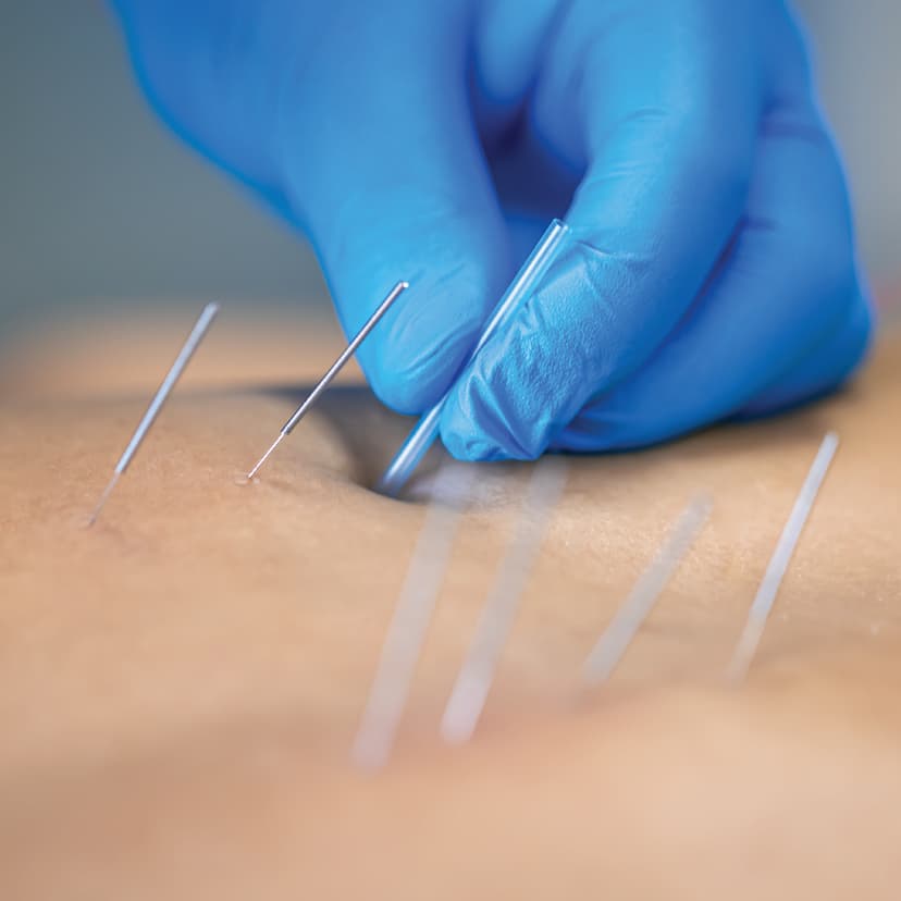 Dry Needling Therapy