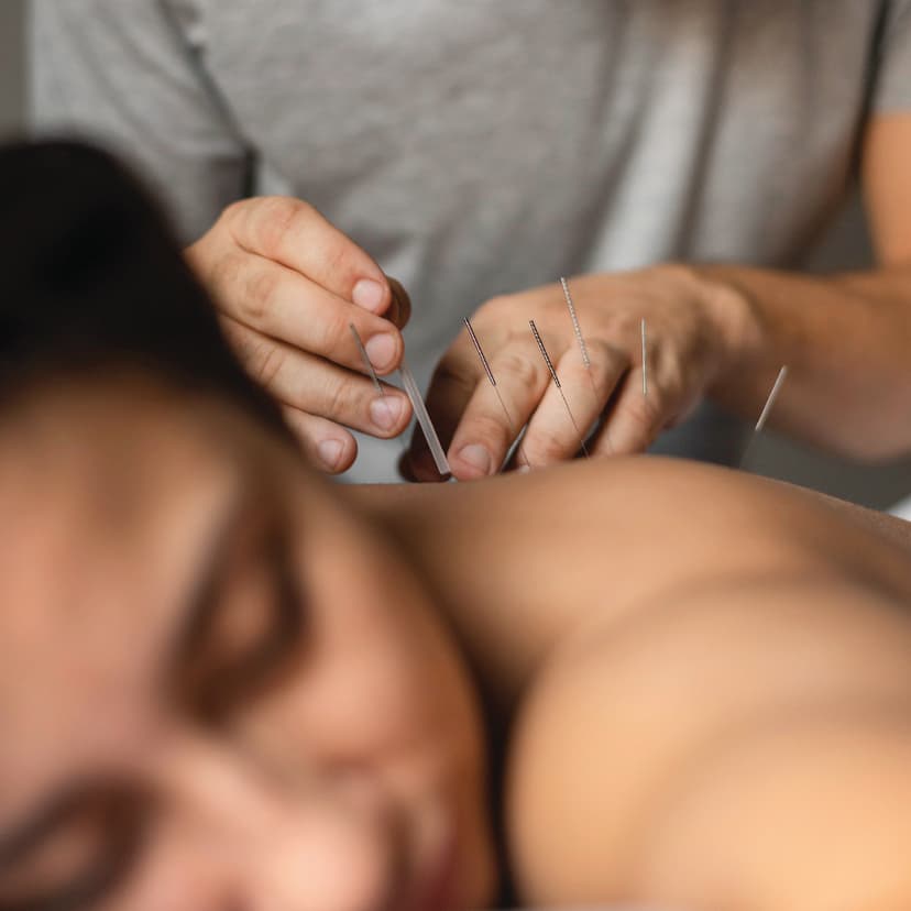 What is Dry Needling