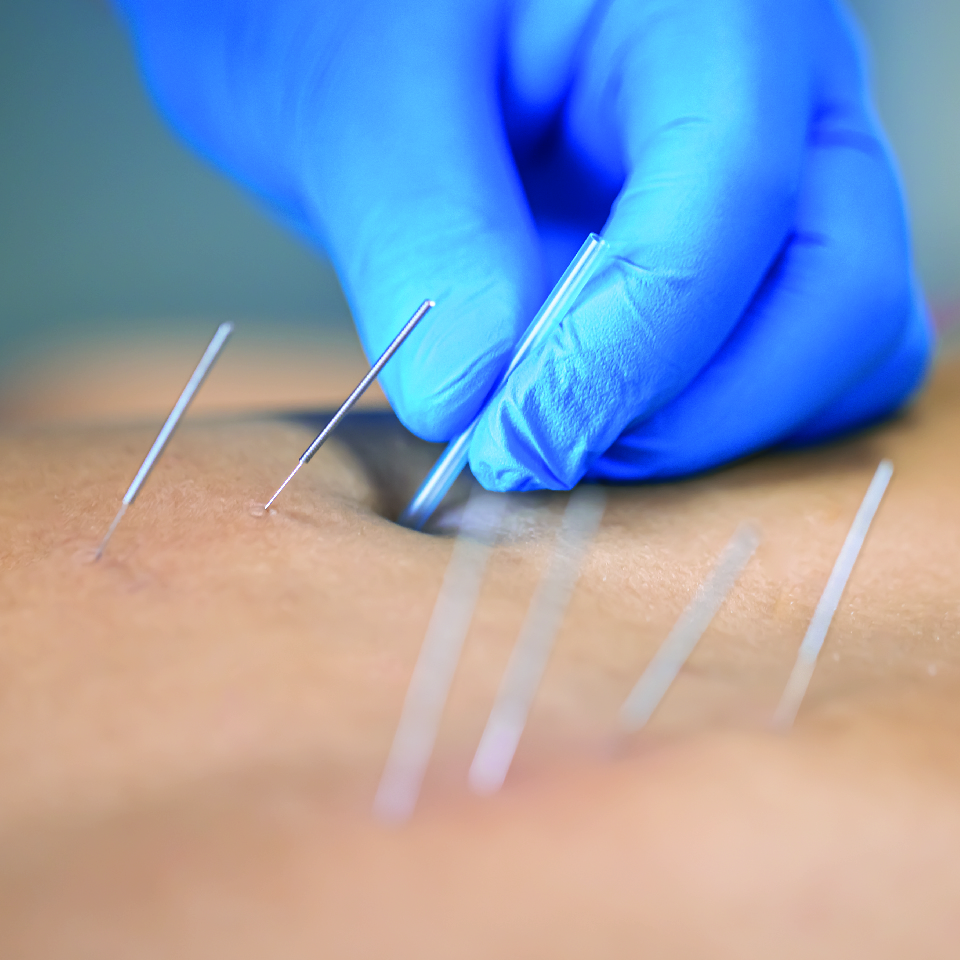Dry Needling Therapy