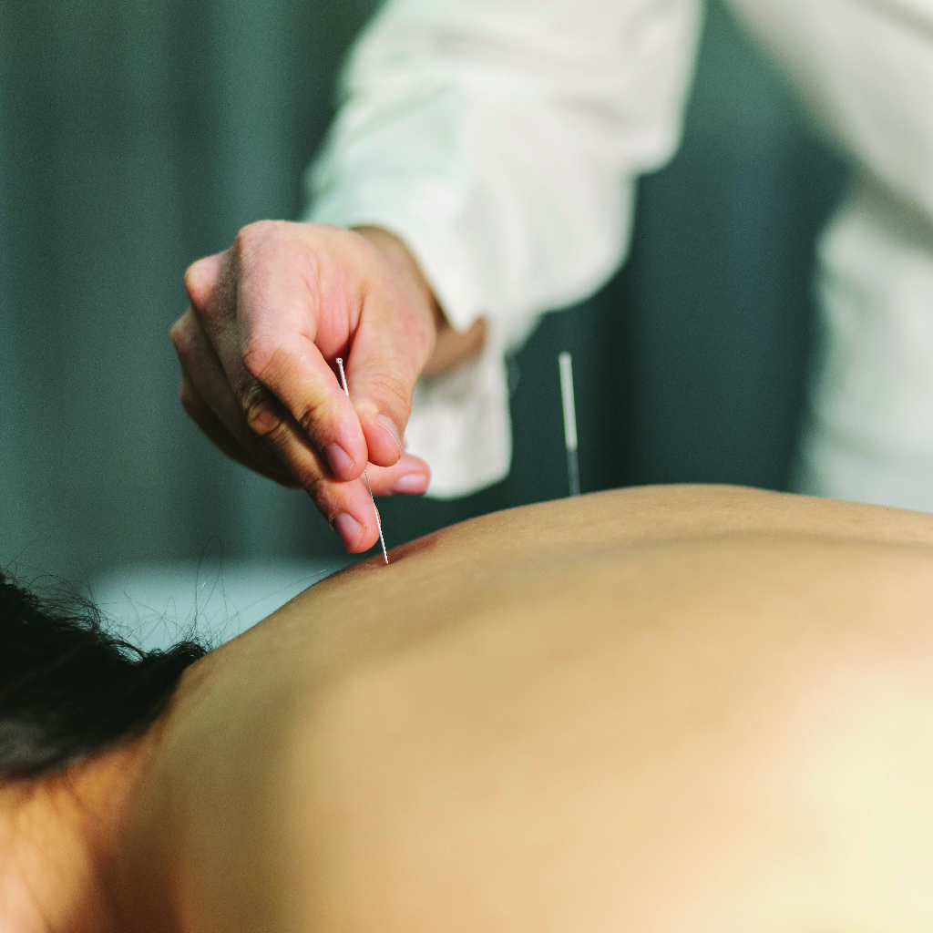 Benefits of Dry Needling Therapy